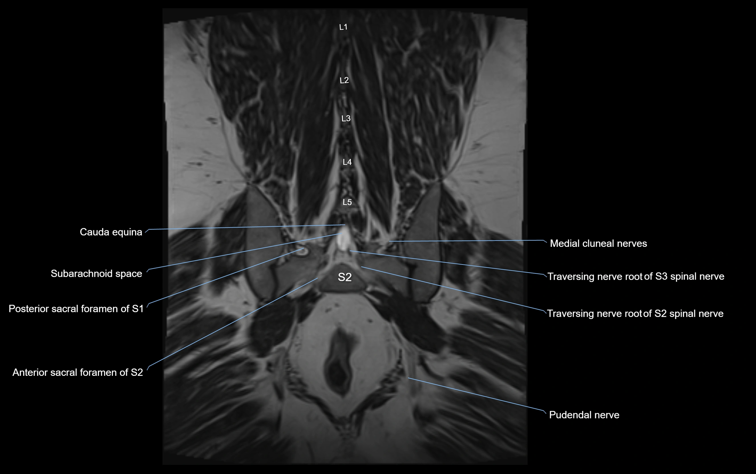 MR lumbosacral plexus cross sectional anatomy 3T  radiology  image-img-09001-00061.webp
